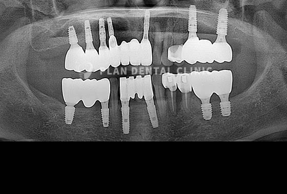 X-RAY 치료 전