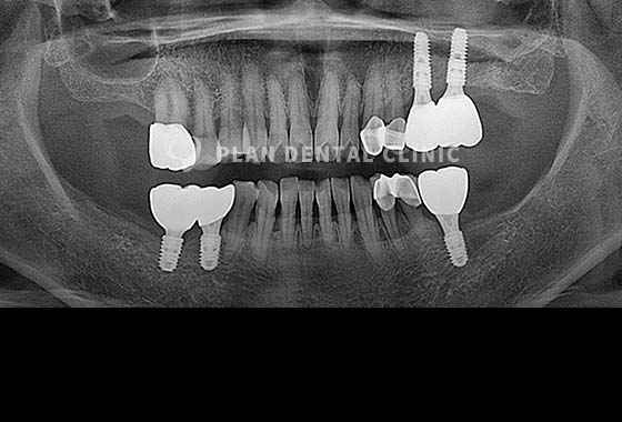 X-RAY 치료 전