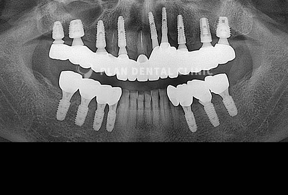 X-RAY 치료 전
