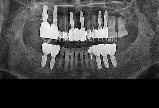 X-RAY 치료 전