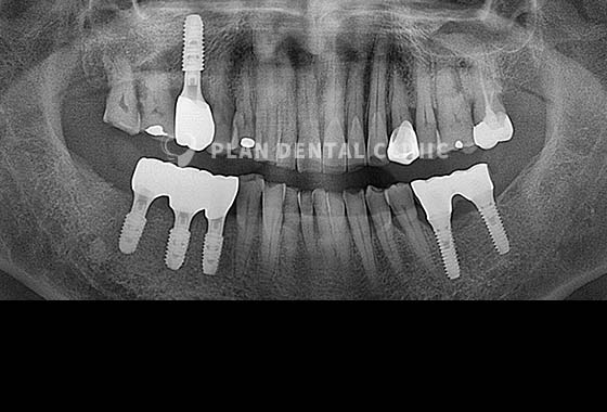 X-RAY 치료 전