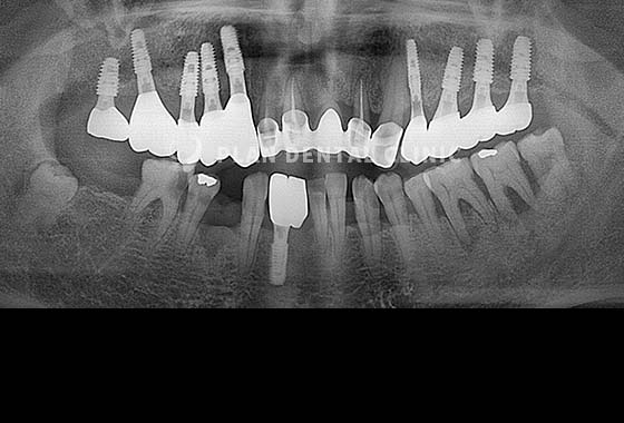 X-RAY 치료 전