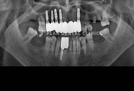 X-RAY 치료 전