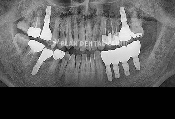 X-RAY 치료 전