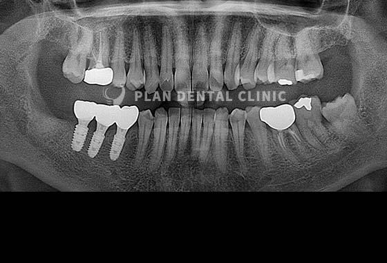 X-RAY 치료 전