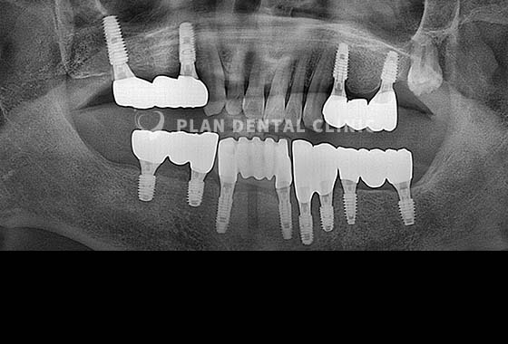 X-RAY 치료 전