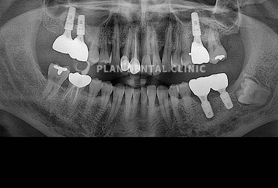 X-RAY 치료 전