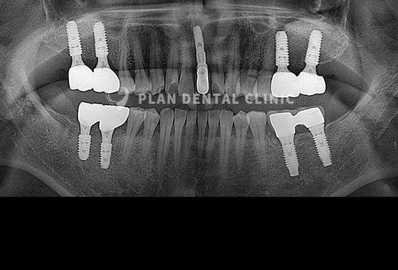 X-RAY 치료 전