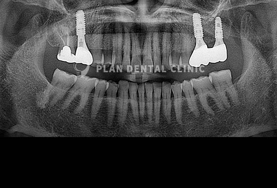 X-RAY 치료 전