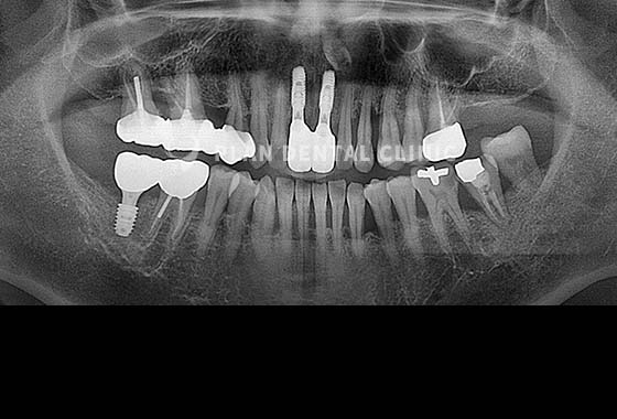 X-RAY 치료 전
