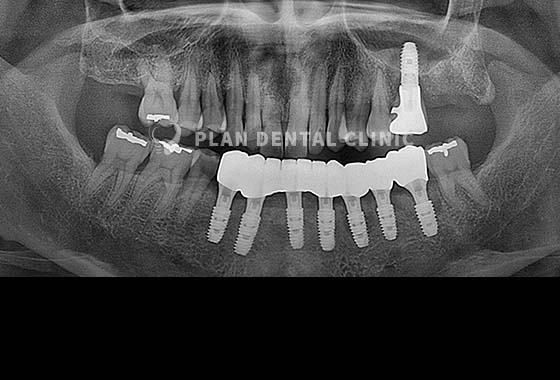 X-RAY 치료 전