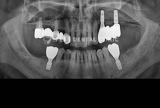 X-RAY 치료 전