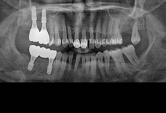 X-RAY 치료 전