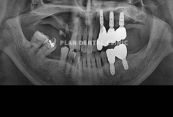X-RAY 치료 전
