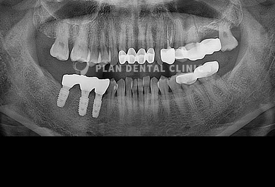 X-RAY 치료 전