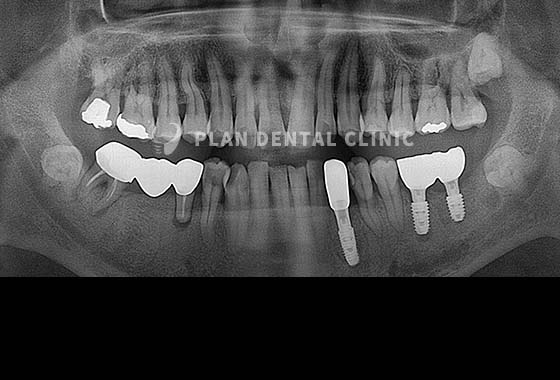 X-RAY 치료 전