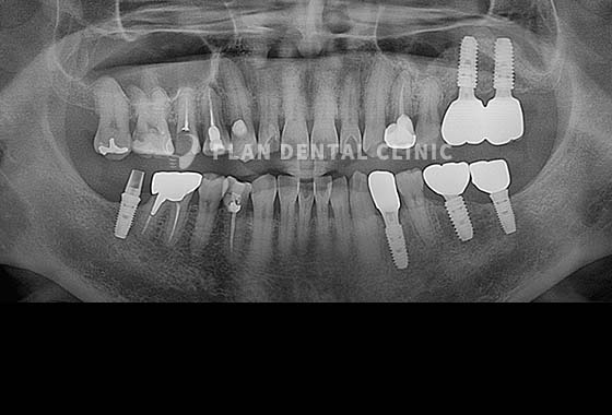 X-RAY 치료 전