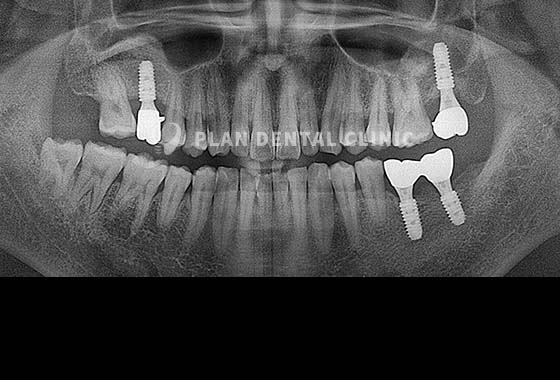 X-RAY 치료 전