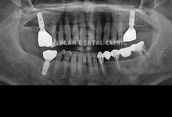 X-RAY 치료 전