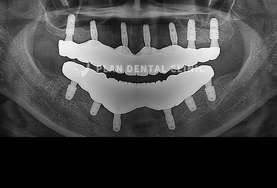 X-RAY 치료 전