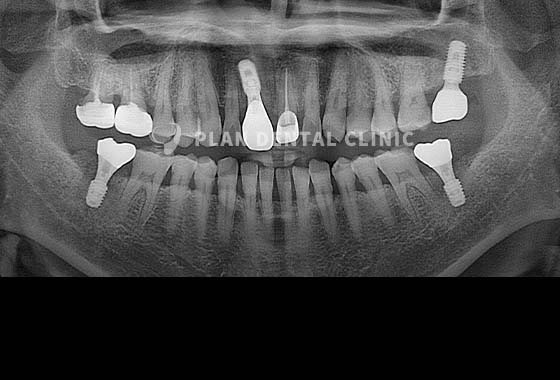 X-RAY 치료 전