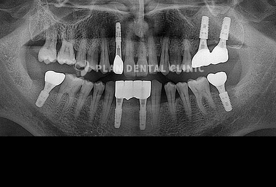 X-RAY 치료 전