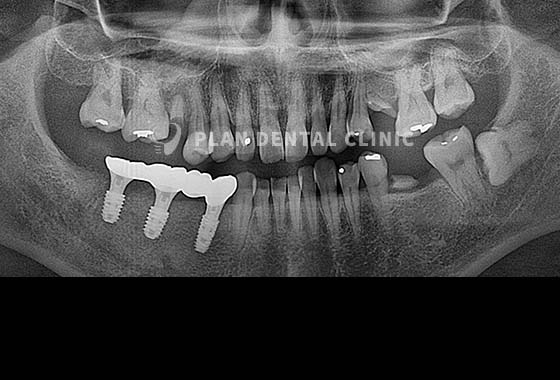 X-RAY 치료 전