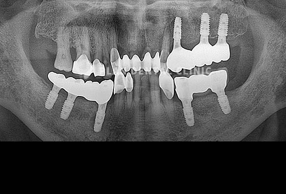 X-RAY 치료 전