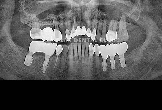 X-RAY 치료 전