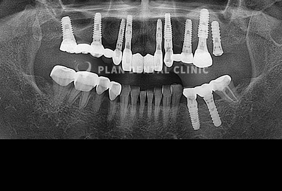 X-RAY 치료 전