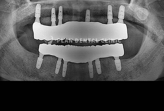 X-RAY 치료 전
