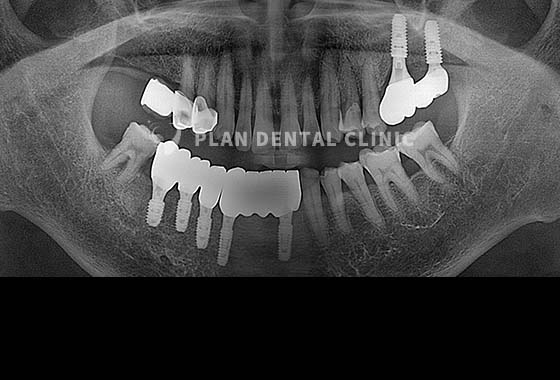 X-RAY 치료 전