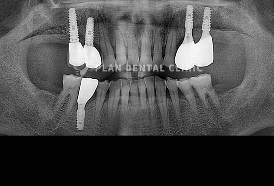 X-RAY 치료 전