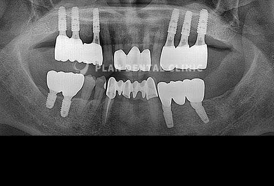X-RAY 치료 전