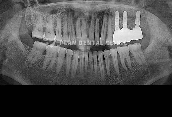 X-RAY 치료 전