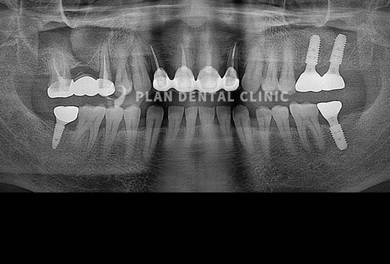 X-RAY 치료 전