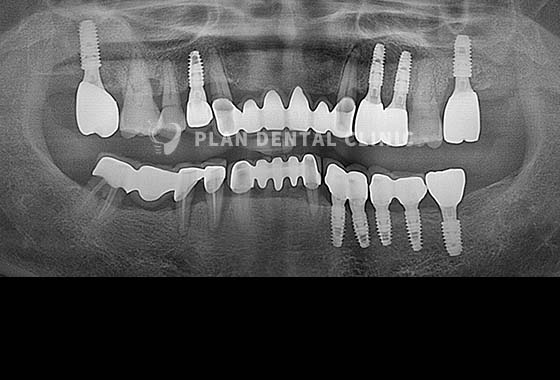 X-RAY 치료 전