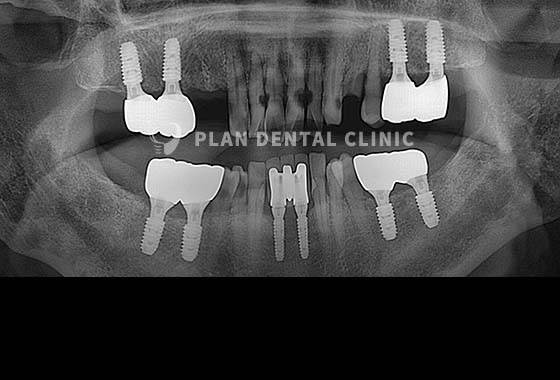 X-RAY 치료 전