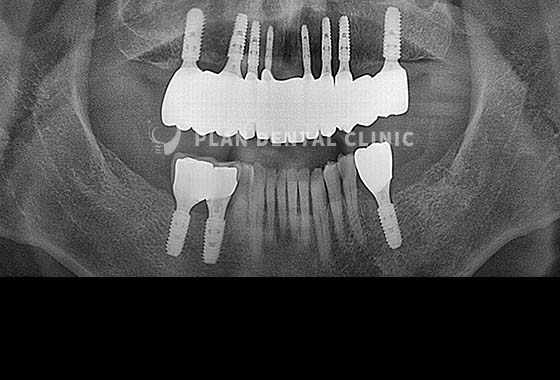 X-RAY 치료 전