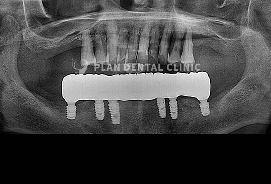 X-RAY 치료 전