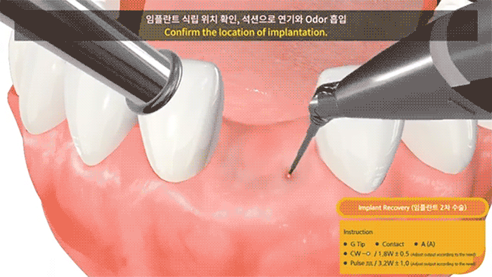 Implant Recovery
