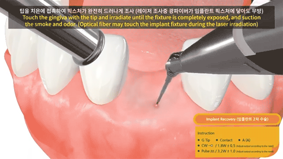 레이저를 이용한 임플란트